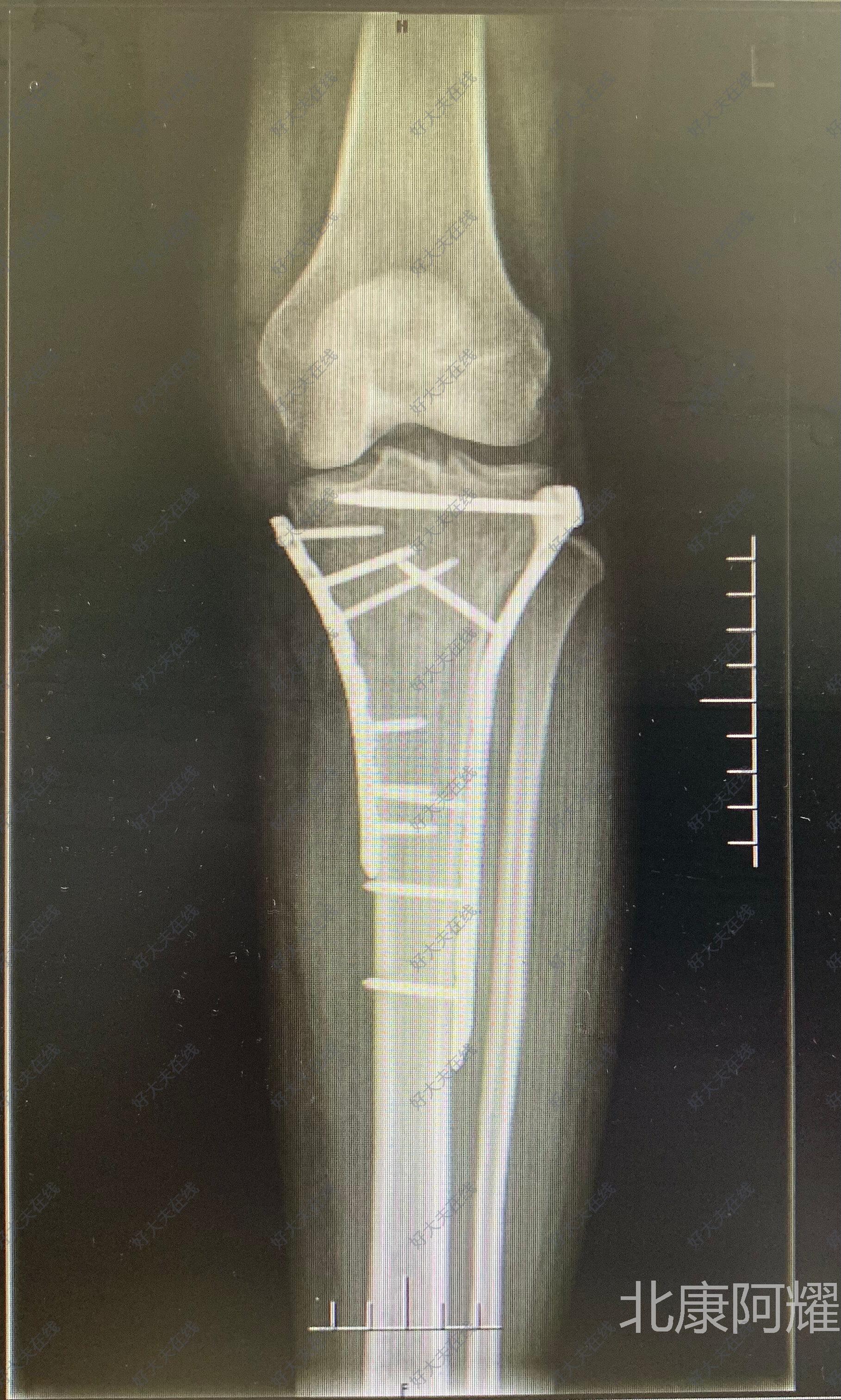 胫骨平台骨折内固定 胫骨平台骨折