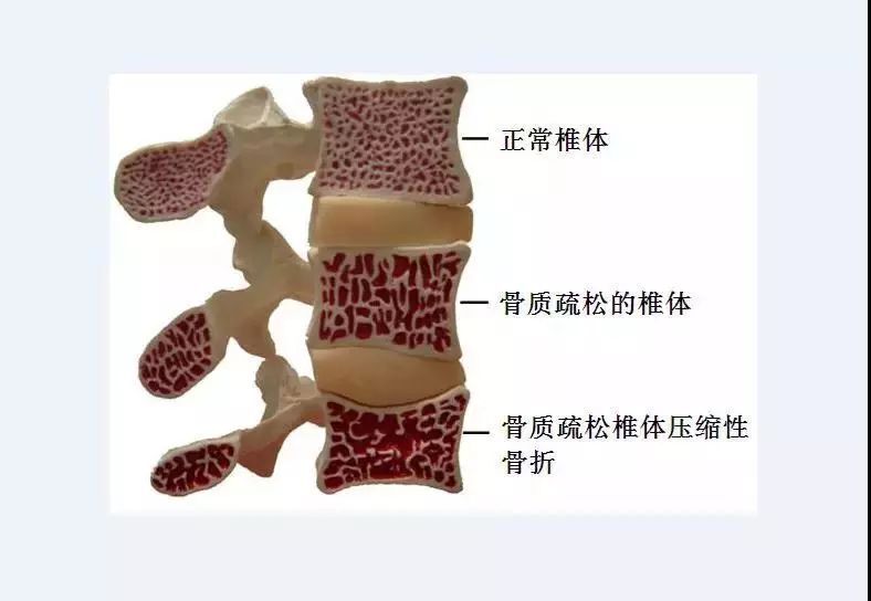 骨皮质松质骨示意图图片