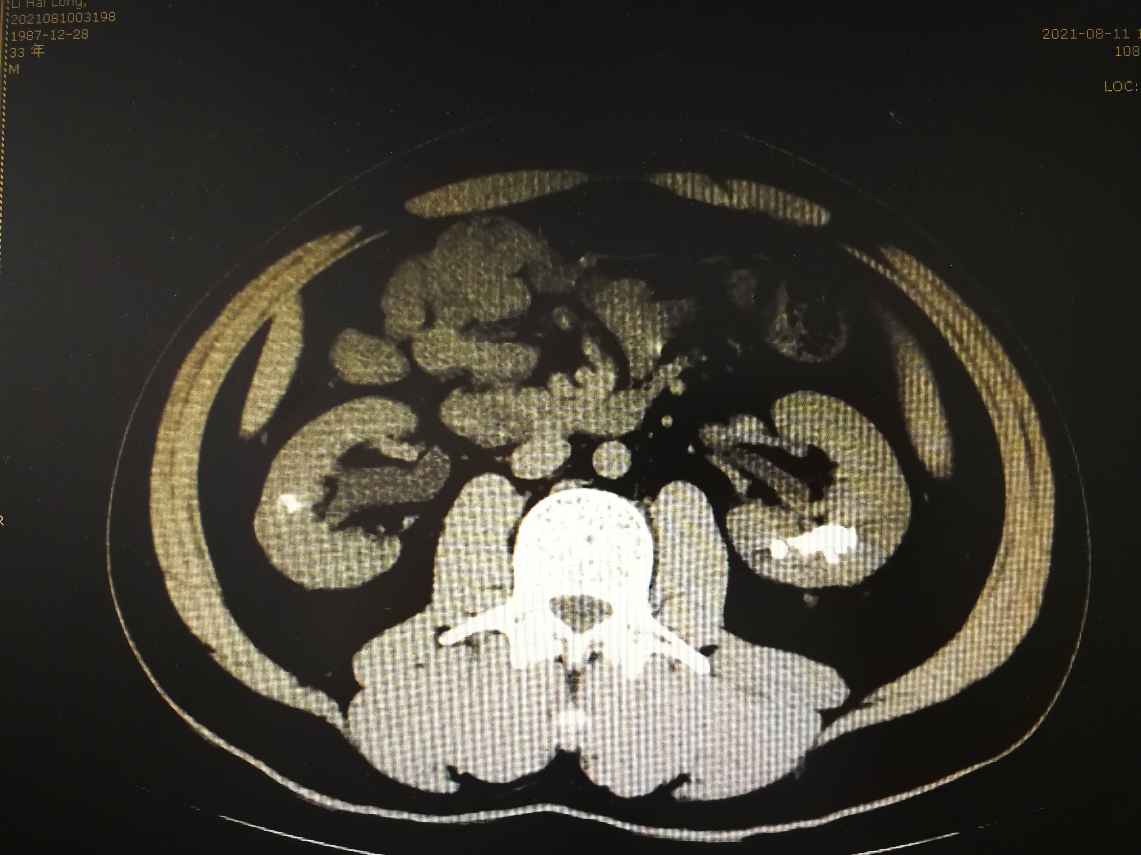 髓质海绵肾CT图片
