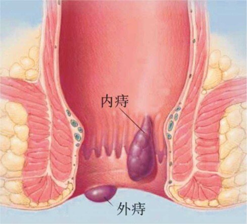 痔疮初期图 轻微图片