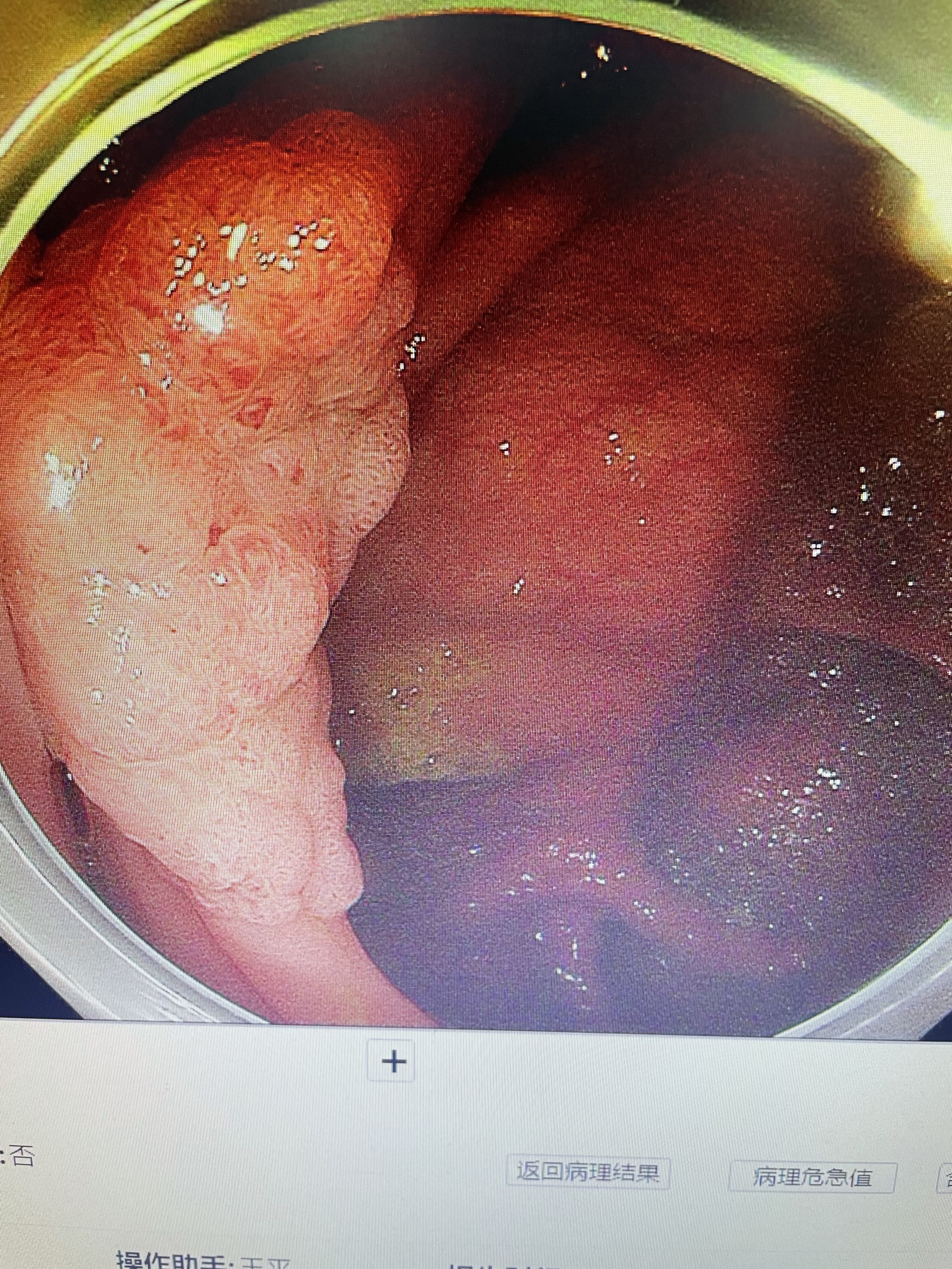 回盲瓣上的结肠早癌 - 好大夫在线