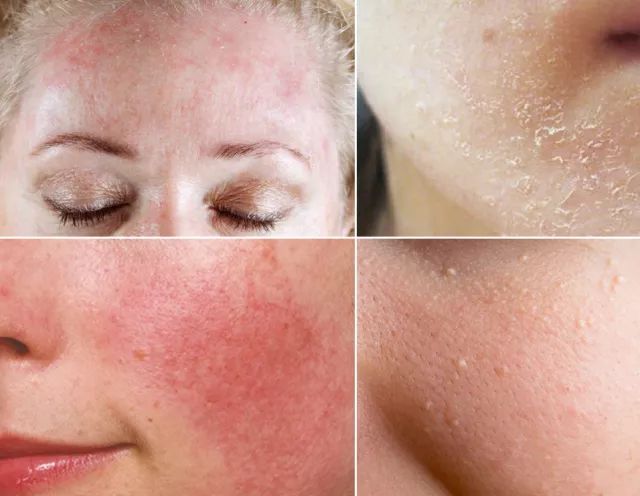 敏感皮肤皮肤过敏你分清了吗?