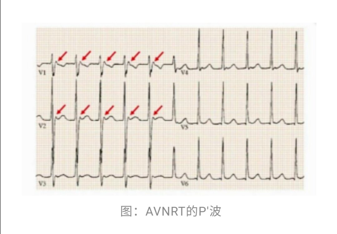 s波p波图片