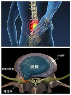 髓核经破裂的椎间盘纤维环突出(或脱出)于椎管方向,导致神经根脊髓等