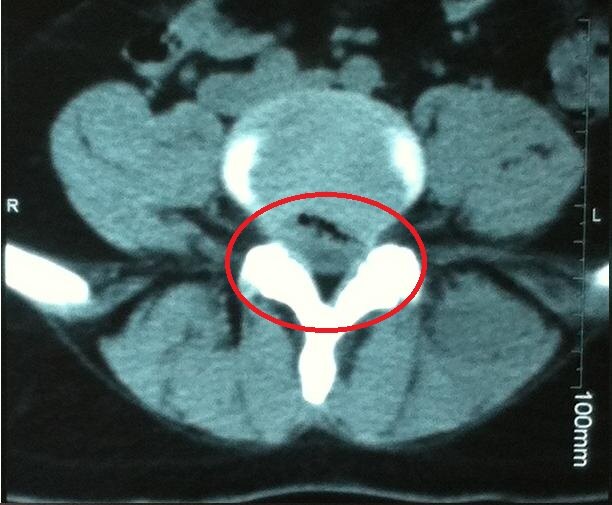 多节段腰椎间盘突出可以微创吗 0YYBAGEp5hCAKmQgAADCbr2oMTw853.jpg?_ms_=9455