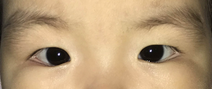 宝宝好像有斗鸡眼对眼要紧吗
