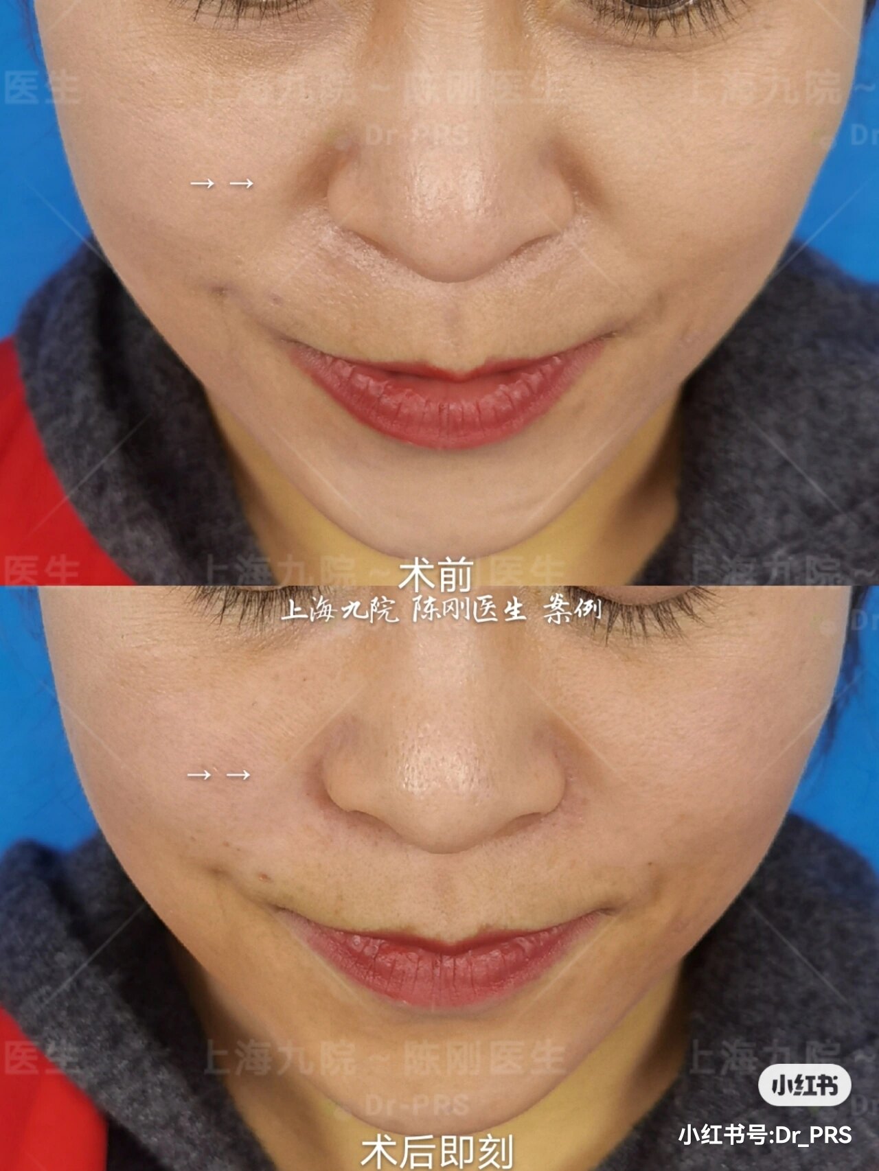 玻尿酸填充鼻基底&法令纹案例 - 好大夫在线
