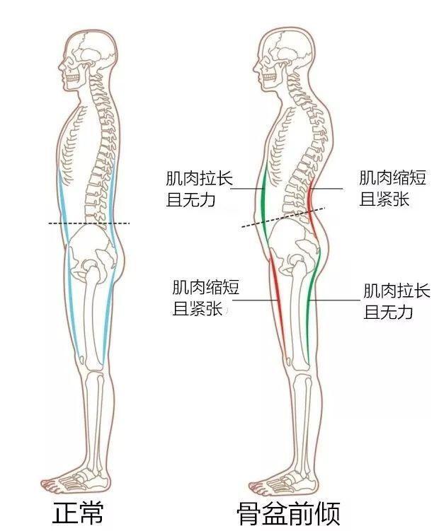 下交叉综合症图解图片