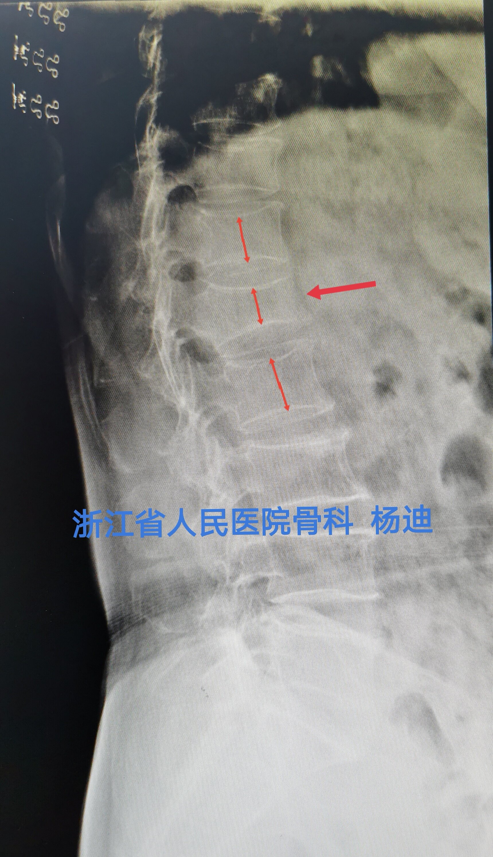 腰椎正位片:箭頭所示為腰1椎體壓縮性骨折,顯示腰1椎體高度丟失.