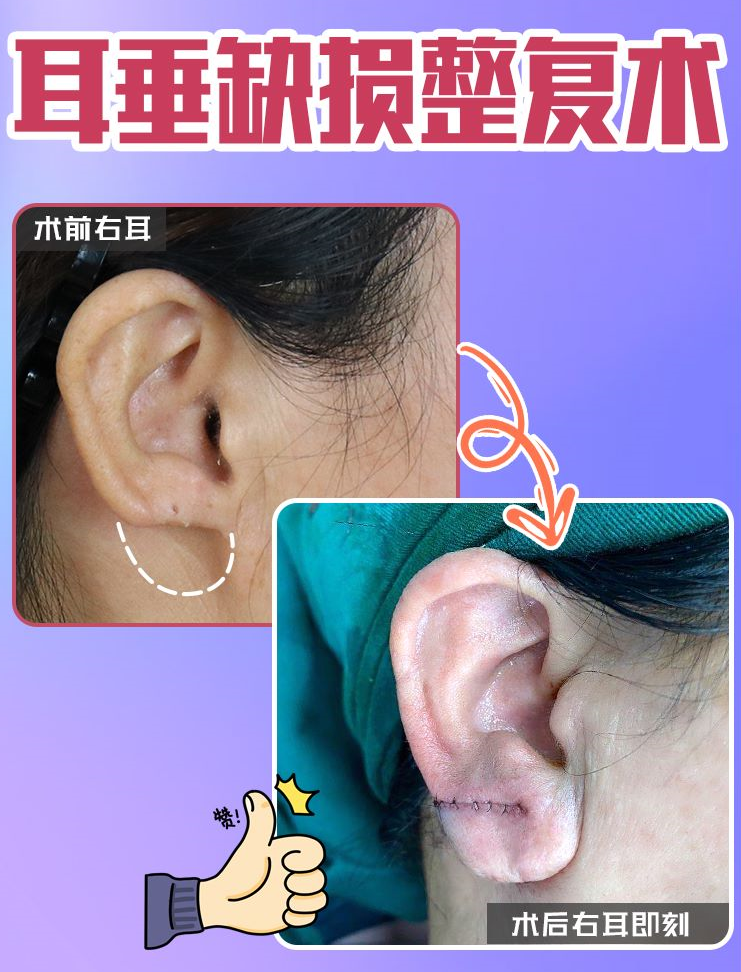 耳垂缺损修复术让耳垂从无变有!