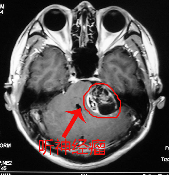 左侧桥小脑角入路(CPA)听神经瘤切除