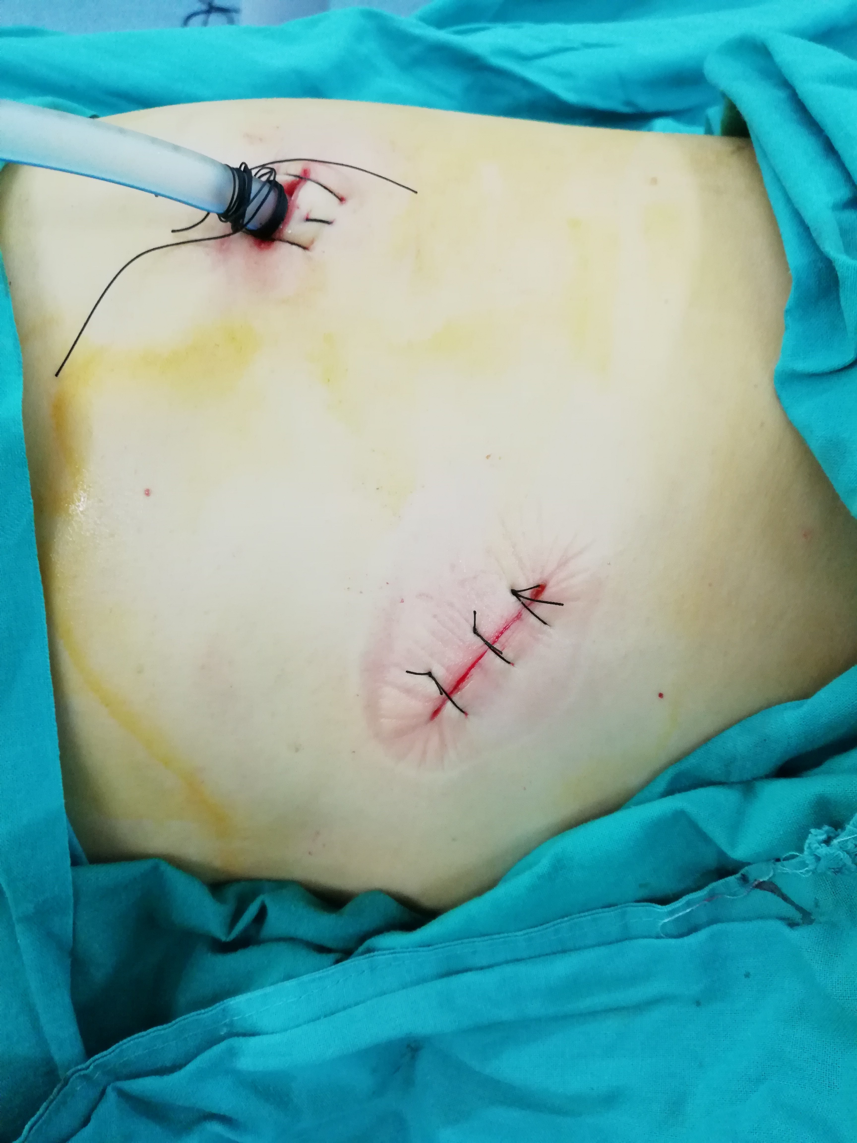 乳腺微创手术刀口图片图片