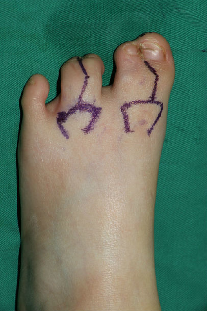 显微外科皮瓣在并趾分趾中的应用 - 好大夫在线