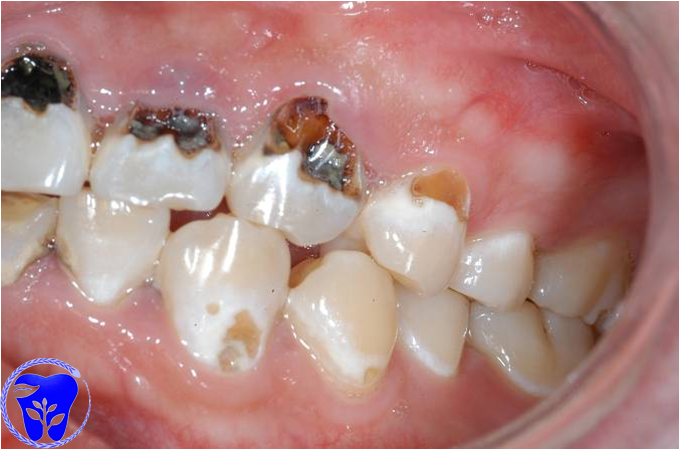 第二磨牙蛀牙图片