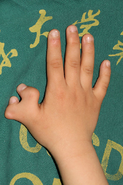 孩子六个手指头,婴儿六个手指头,宝宝六个手指怎么回事 