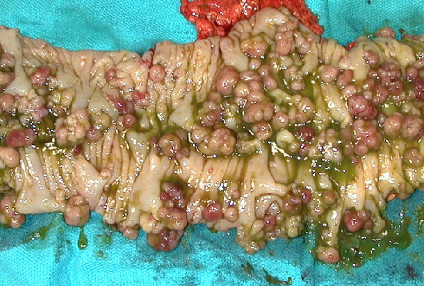 下表现fap肠镜下表现结直肠息肉病是指结直肠中有超过100枚息肉的患者
