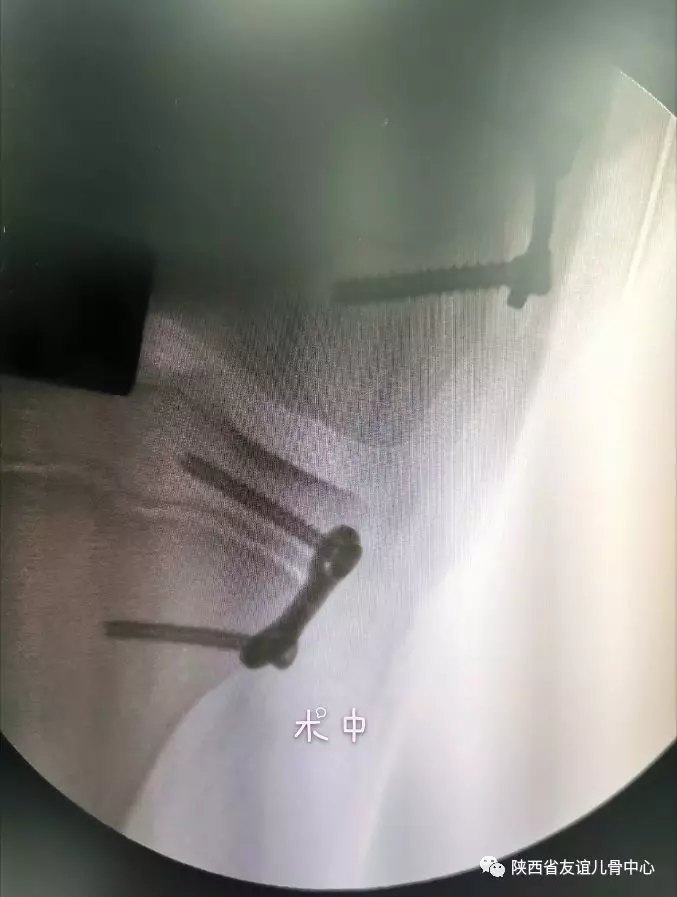 膝外翻手术图片