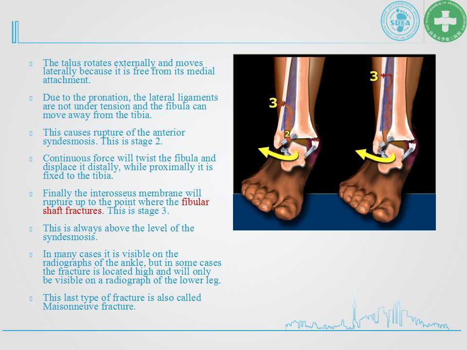 踝关节骨折的分型 - 好大夫在线