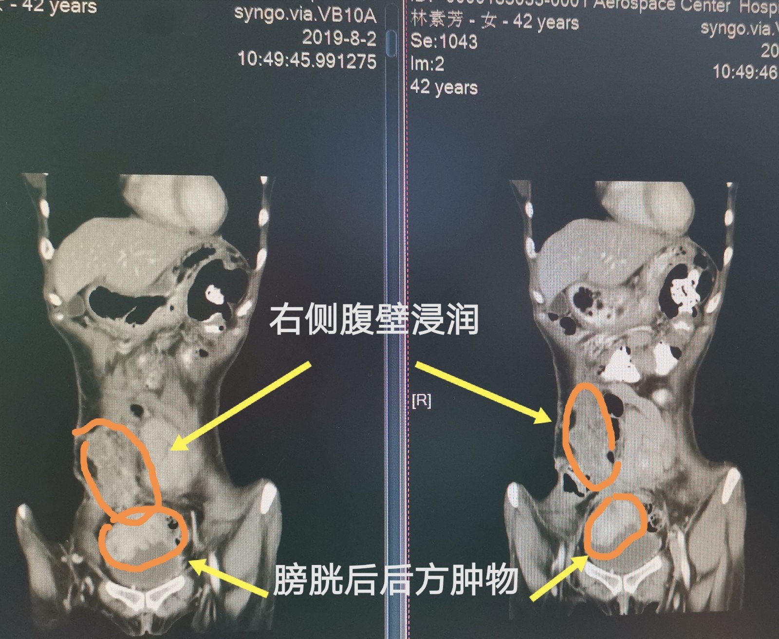 膀胱鏡置雙側d-j管,膀胱三角正常;ct:右側腹壁腫物及膀胱右後壁腫物