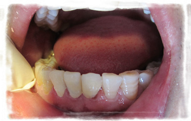 纤维桩核冠美容修复下前牙残根病例