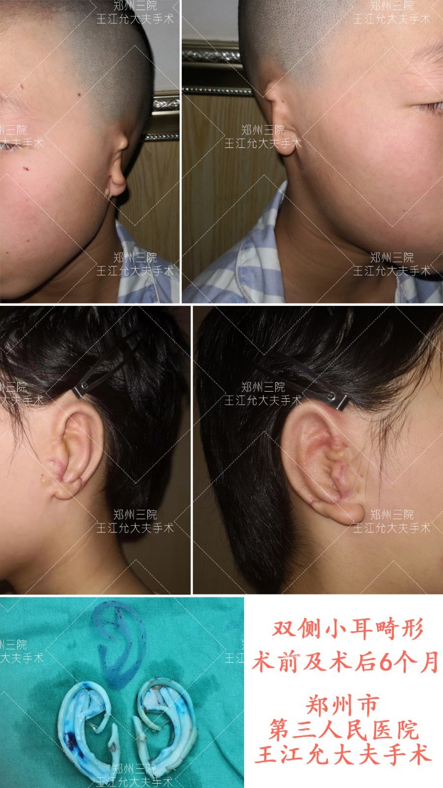 各种耳再造手术方法的区别与优缺点_耳再造_耳再造治疗介绍 - 好大夫