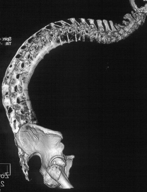 术前ct三维重建显示整个脊柱完全畸形融合,腰12椎间盘处还有假关节