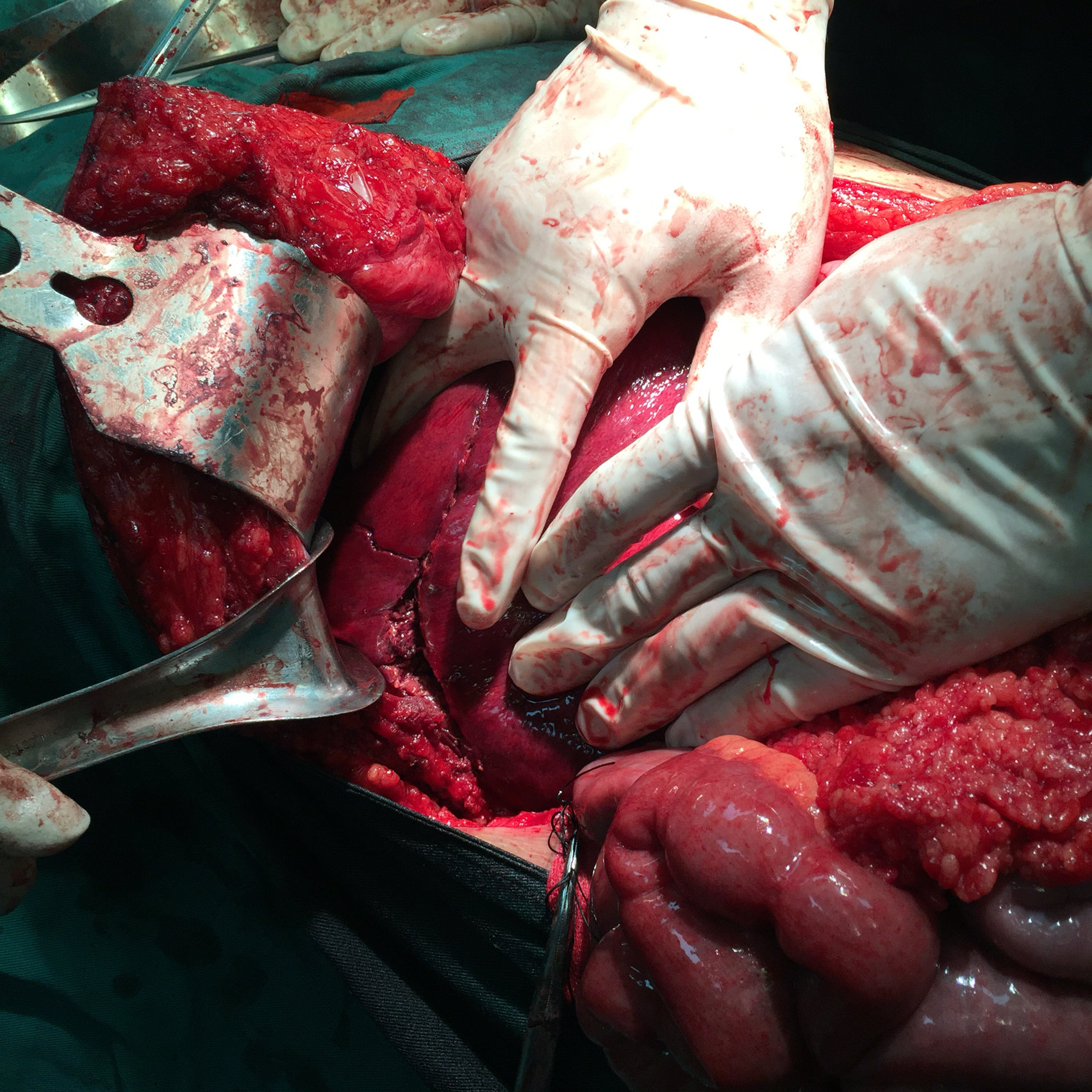 外伤肝破裂手术时及一周后 - 好大夫在线