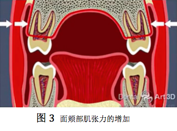 舌體也被牽引向下,使上頜牙弓顎側失去舌肌力量的