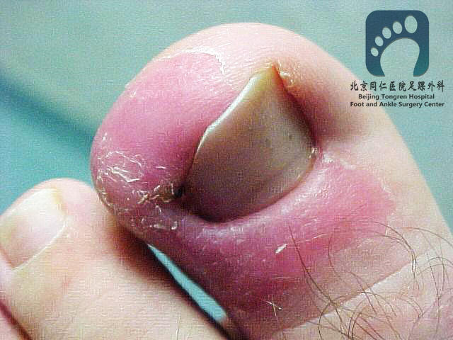 嵌甲的处理技巧与手术治疗