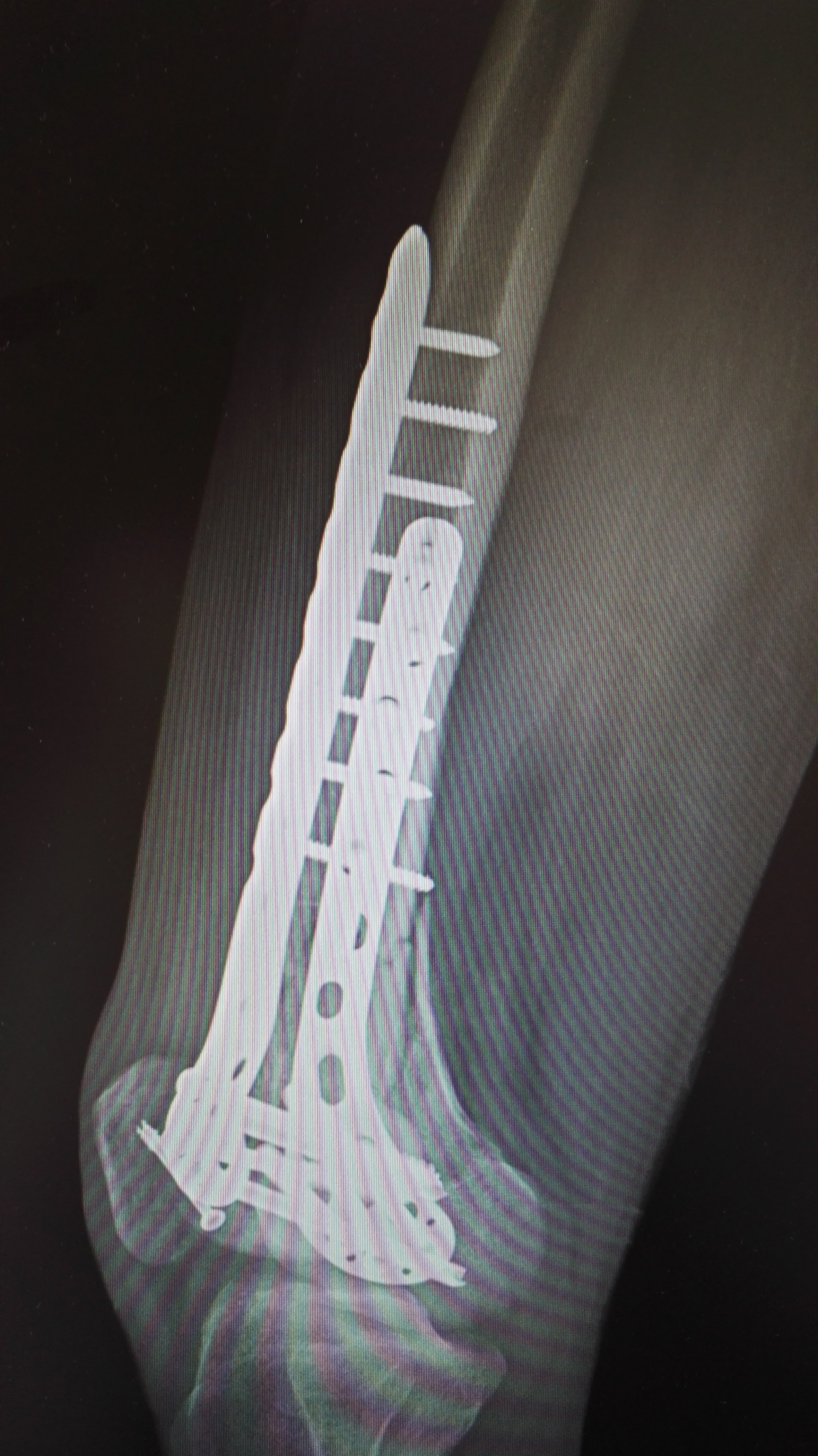 下肢股骨远端骨折1例,伴髌骨骨折 - 好大夫在线