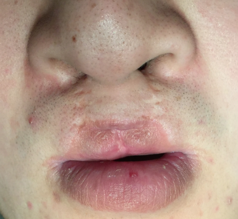 双侧唇裂的二期修复交叉唇瓣手术. - 好大夫在线