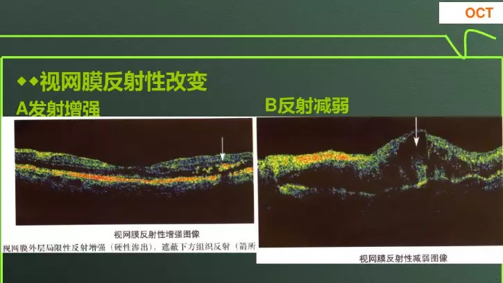 oct結果解讀ppt