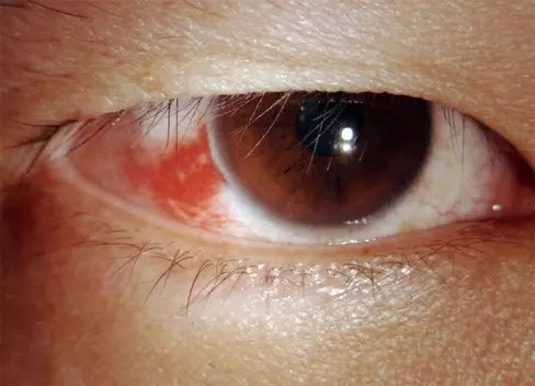 眼睑结膜裂伤图片
