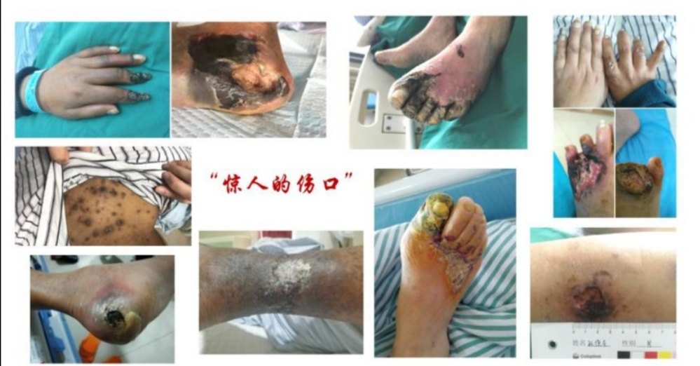 什么是钙化防御? - 好大夫在线