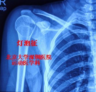 在肩关节正位片,或者是肩胛骨正位片上,可以看到肱骨头旋转脱位后骨小
