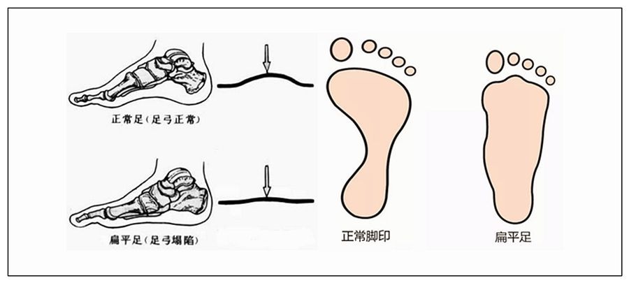 扁平足会不会遗传 引起扁平足是这2大原因 扁平足 遗传 手术 扁平足会不会遗传 引起扁平足是这2大原因 扁平足 遗传 手术