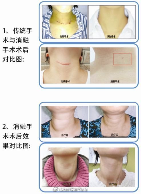 甲狀腺結節無疤消融手術很微創但不要濫做來自陝西省甲狀腺消融經驗最