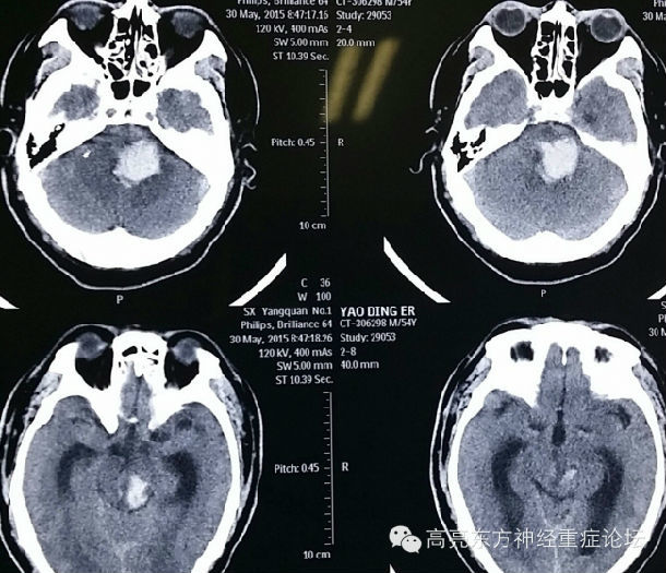 圖1患者5月30日在山西某地突然起病,頭顱ct提示腦幹血腫,合併幕上急性