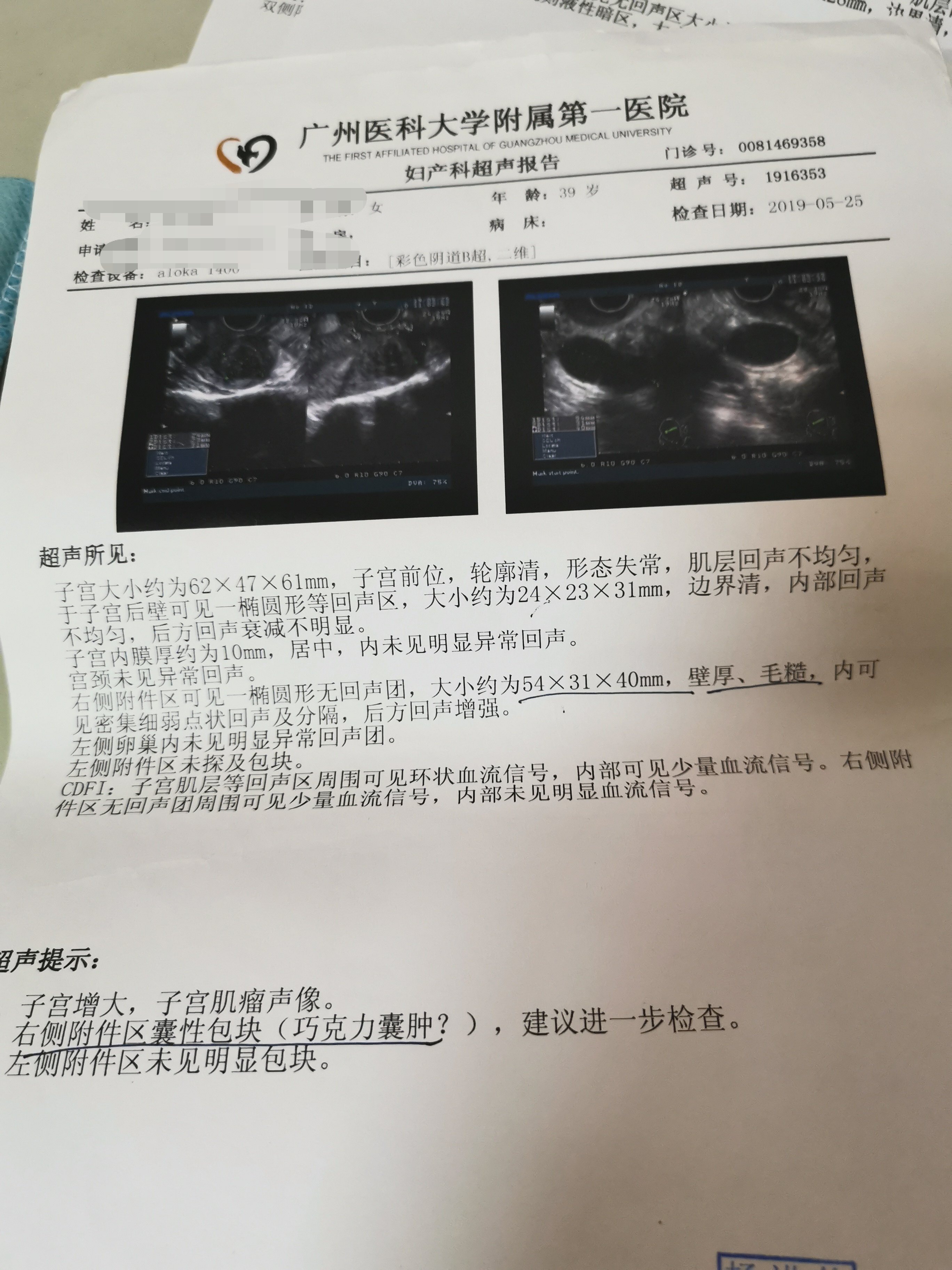 中藥治療卵巢巧克力囊腫效果不錯