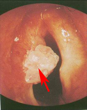 咽喉癌早期图片图片