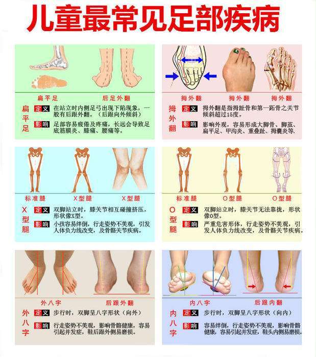 通过哪些细节可以发现孩子患有马蹄足