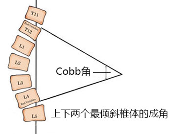 脊柱侧弯cobb角分级图片
