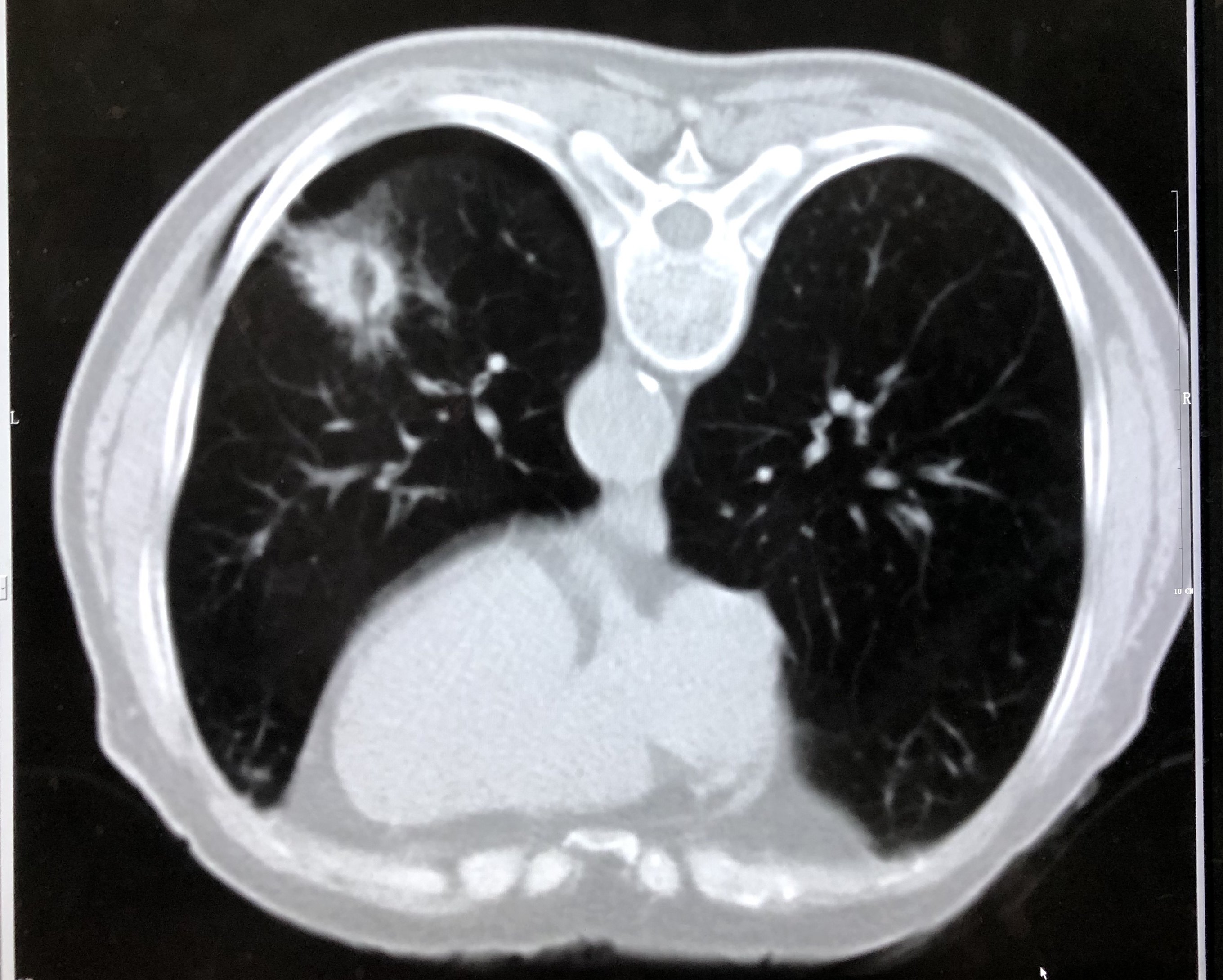 ct下穿刺肿瘤取组织送病理检查左肺占位影像学考虑肺癌