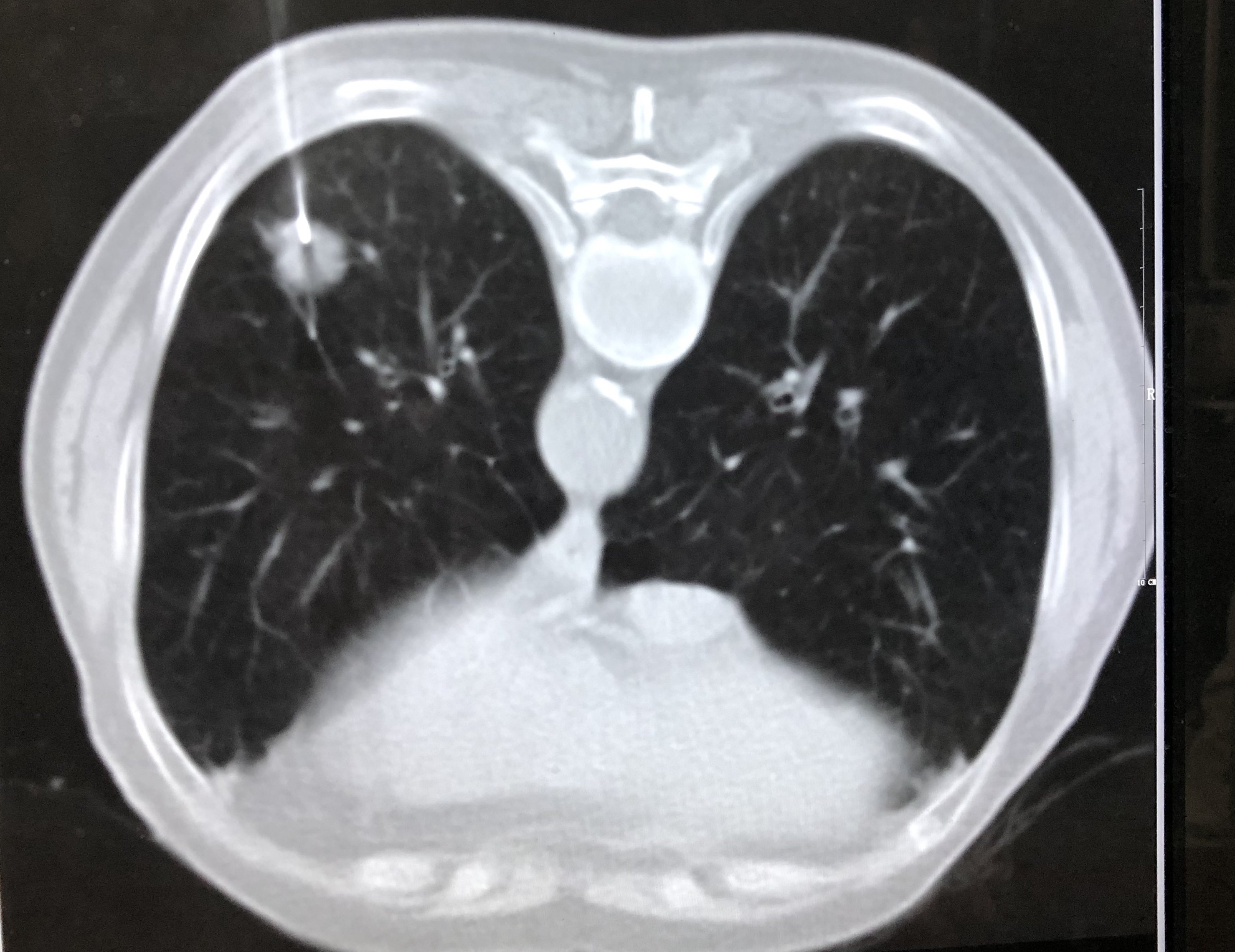 左肺占位ct下活检加微波消融案例分享 