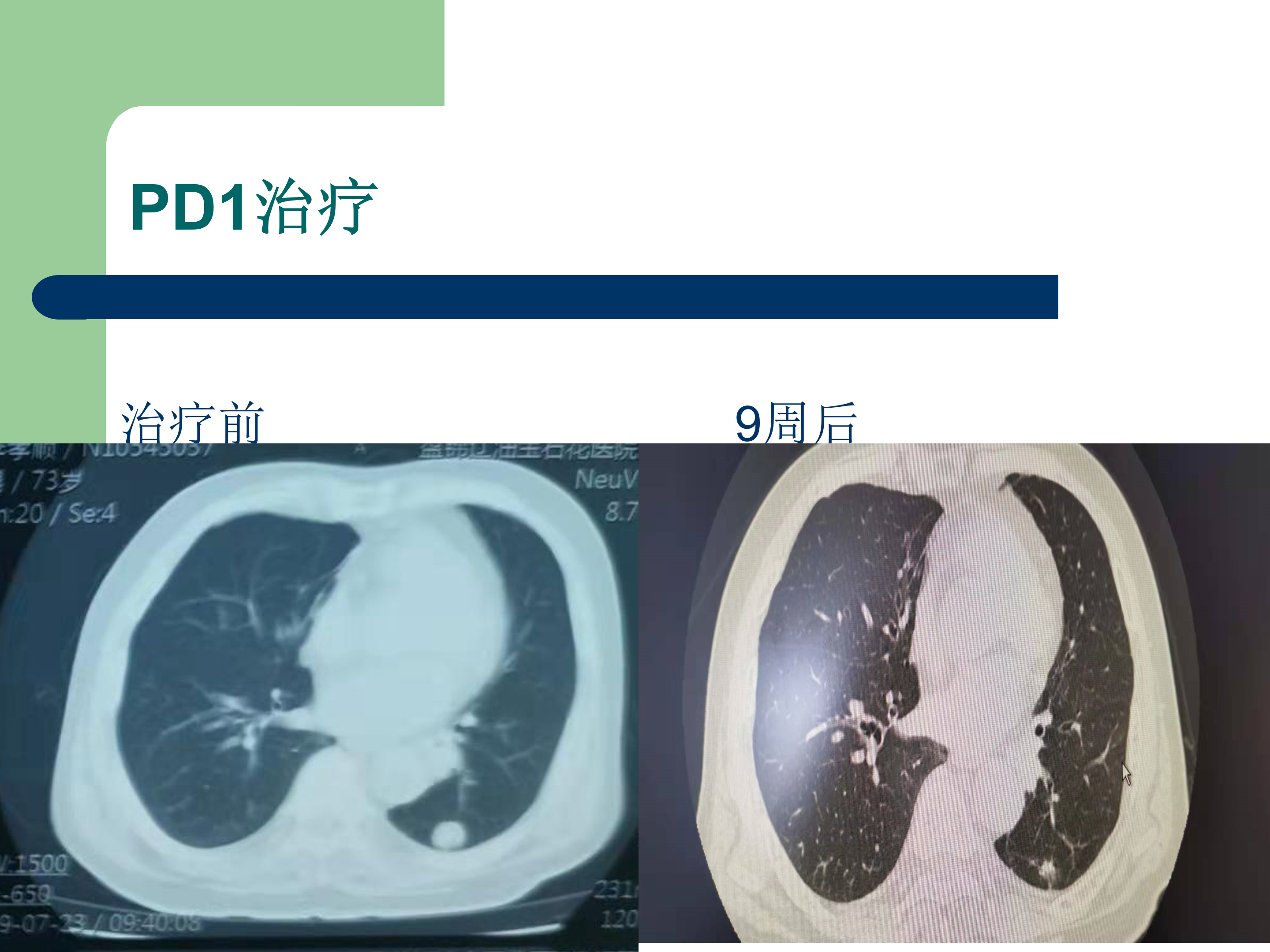 pd1治疗晚期肺癌经典病例