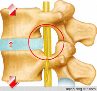 腰椎间盘突出症如何自我进行保守治疗