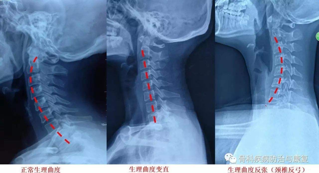 頸椎病腰椎病要做哪些檢查x片ct還是磁共振