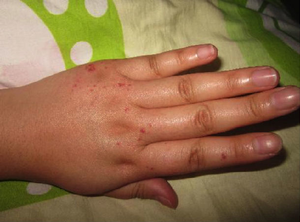 血管角皮瘤 - 好大夫在线