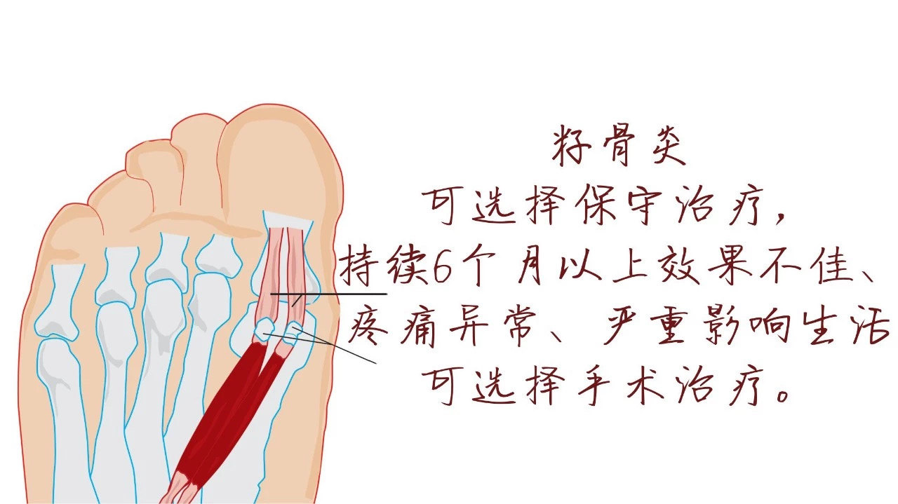 脚趾痛的罪魁祸首竟是它 籽骨炎 关节炎 关节炎 脚趾痛的罪魁祸首竟是它 籽骨炎 关节炎 关节炎