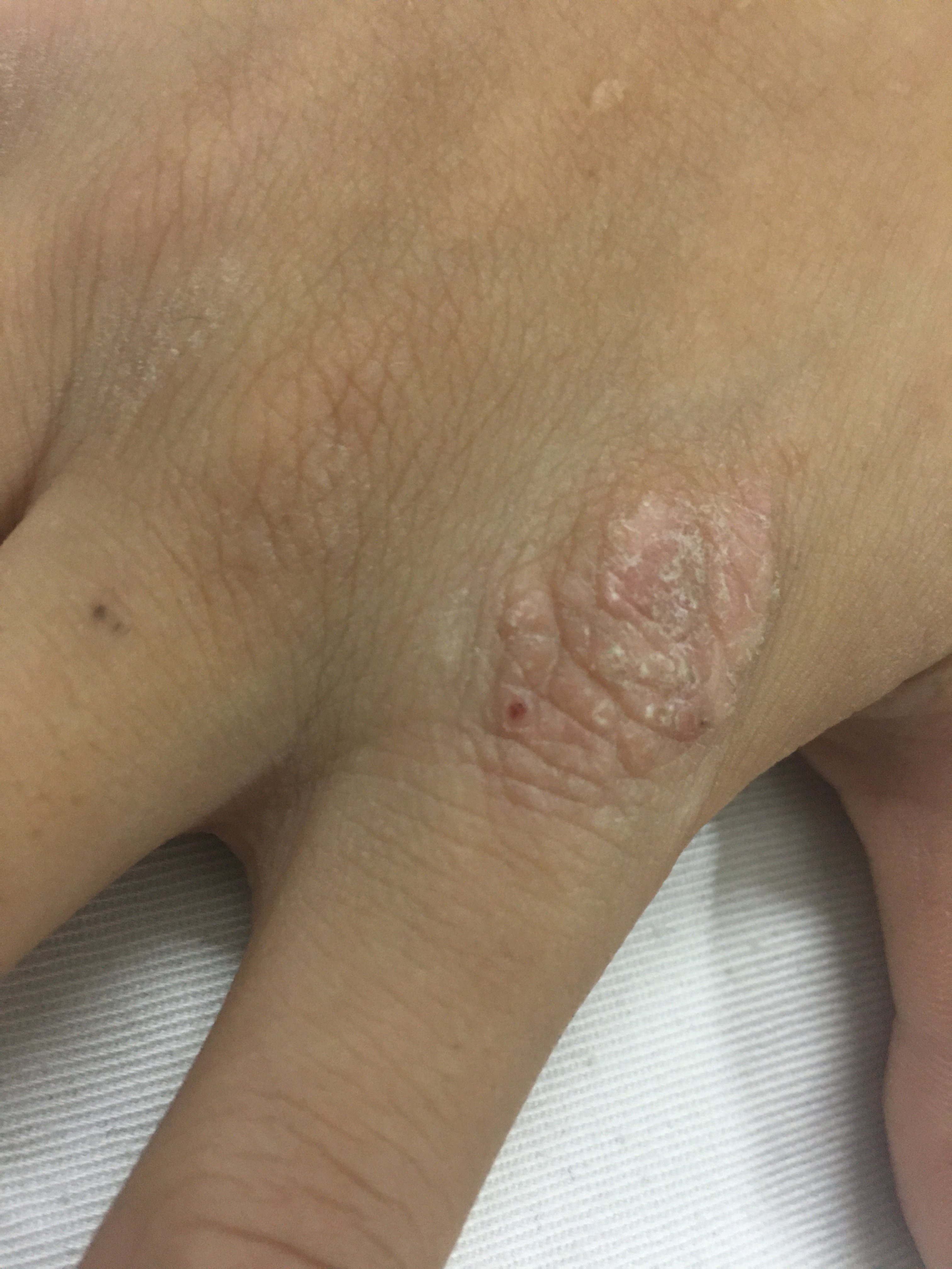 神经性皮炎 - 好大夫在线